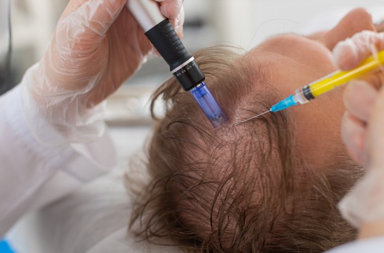 Haarausfall falsch behandelt