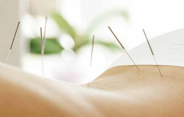Akupunktur - Kann chinesische Medizin wirklich helfen?