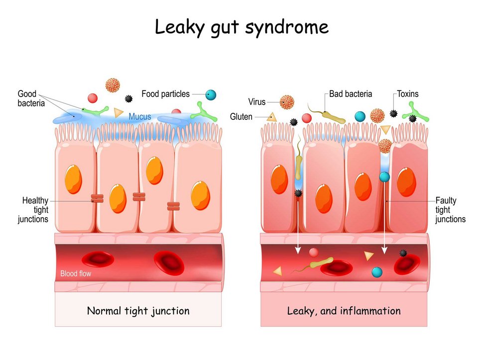 Immer mehr Menschen leiden am Leaky Gut Syndrom