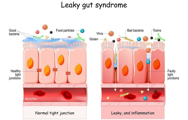 Immer mehr Menschen leiden am Leaky Gut Syndrom